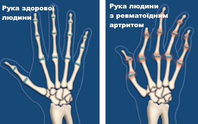 revmatoidnyiartrytruky (1)