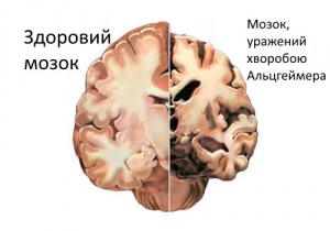 Хвороба Альцгеймера: своєчасне виявлення перших симптомів