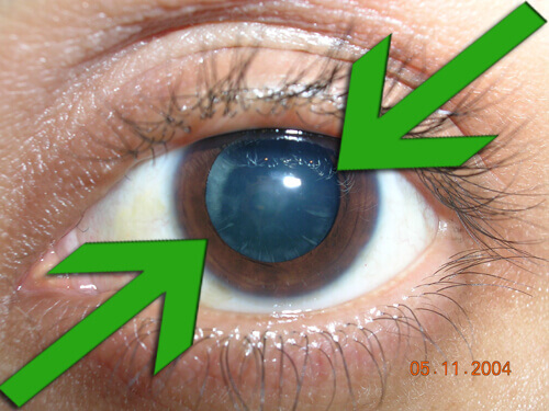 Натуральне лікування та профілактика катаракти