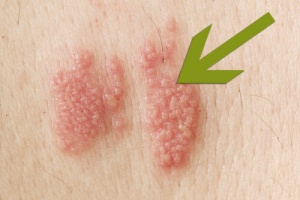 Оперізуючий герпес: що це і як це виглядає?