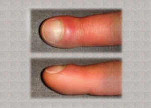 Що спричиняє набряк пальців?
