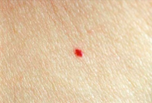 червона родимка