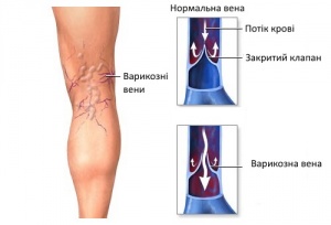 Як заспокоїти біль людям, які страждають на варикозне розширення вен