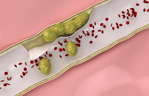 Arterii