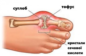 Подагра: симптоми та способи лікування