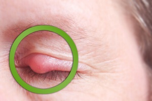 Як швидко вилікувати ячмінь