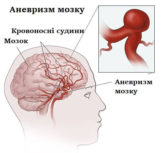 аневризма головного мозку