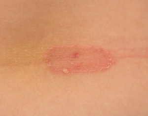 Як лікувати грибок стоп