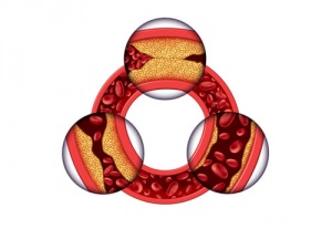 Як знизити рівень холестерину у жінок?