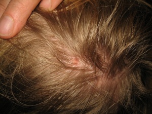 Як вивести вошей природним шляхом