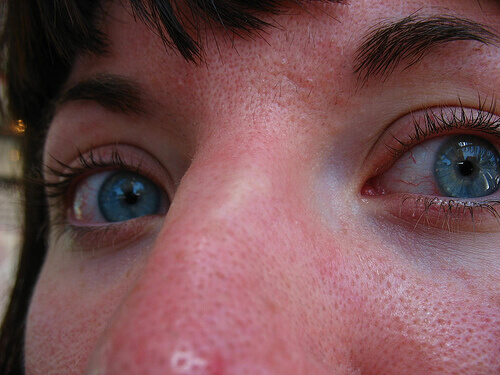 чорні цятки на носі