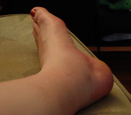 набряки щиколоток