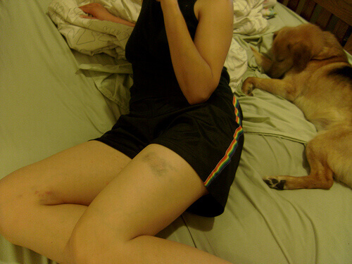 синці на ногах