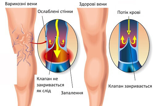 Корисні вправи при варикозному розширенні вен Корисні вправи при варикозному розширенні вен