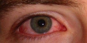 Почервоніння очей: причини і прості засоби лікування