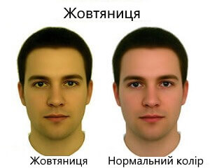 ознаки отруєної печінки: жовтяниця