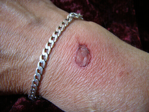 опік в ділянці пердпліччя