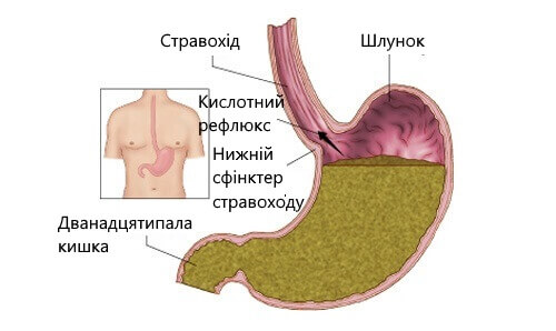 шлунковий рефлюкс