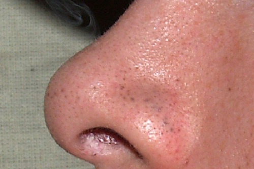 Як почистити шкіру від чорних цяток (комедонів) природним способом