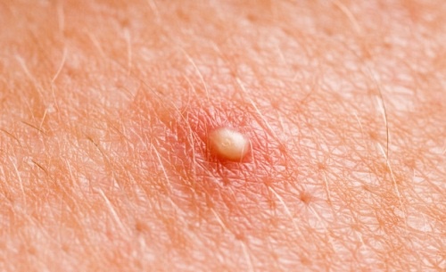 Домашні засоби від фурункулів