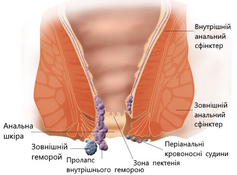 схематичне зображення геморою