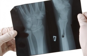 Продукти, які шкідливо впливають на здоров'я кісток