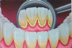 Як усунути зубний наліт природним способом