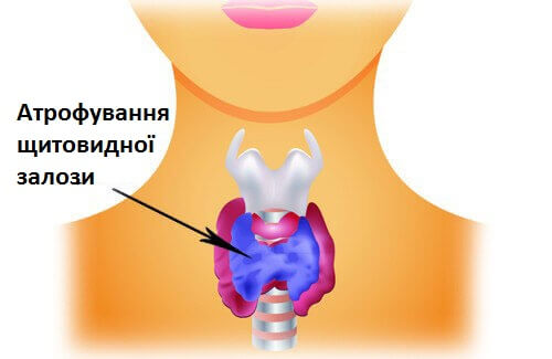 Гормональні проблеми: Гіпотиреоз