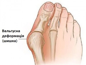 Чому з'являється "шишка" - кісточка на нозі