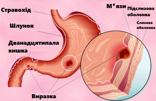 Природне лікування виразки шлунку