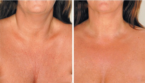 Засоби для зменшення зморщок на шиї