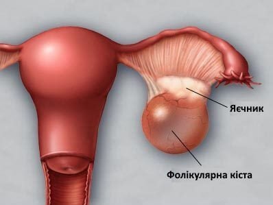 Раннє виявлення та профілактика кісти яєчника