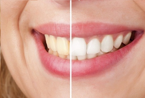 відбілювання зубів серед шкідливих звичок