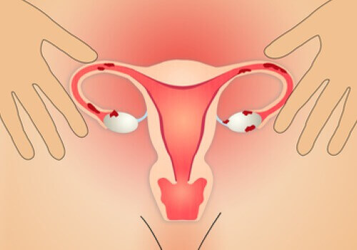 Харчування для лікування ендометріозу тіла матки