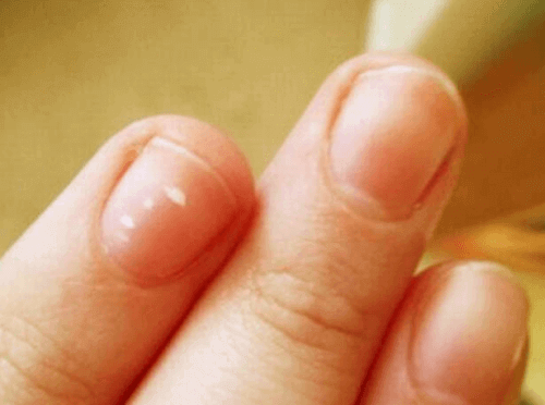 білі плями у вигляді "хмарок" на нігті