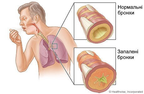 запалення бронхів