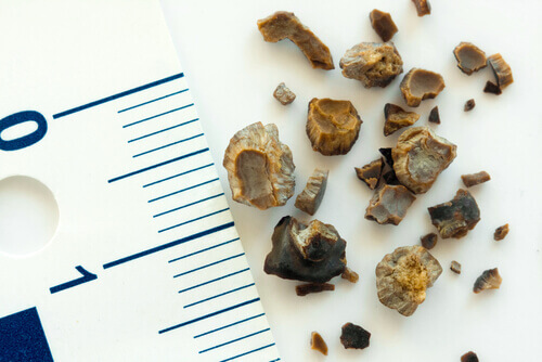 камені у нирках можуть мати різні розміри