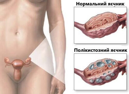 9 фактів про кісту яєчника, які повинна знати кожна жінка