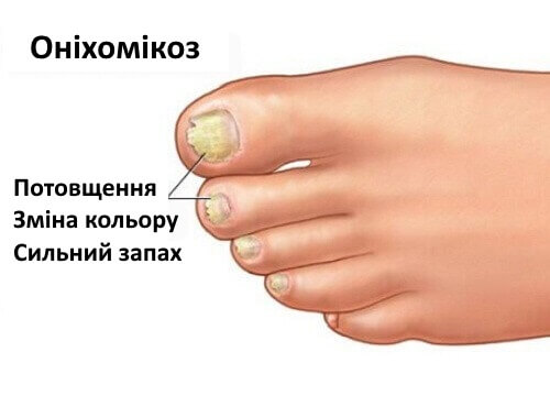 Оніхомікоз: грибок нігтів