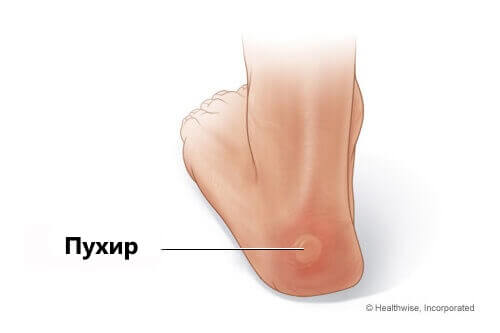 Пухирі на ногах