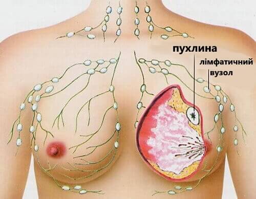5 найбільш поширених видів раку у жінок