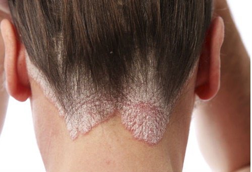 Домашні засоби для боротьби з лупою та себореєю