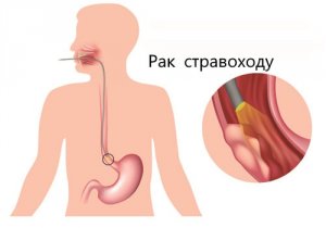 Симптоми найважливіших хвороб стравоходу