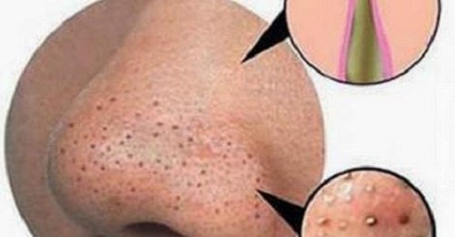 Прищі та чорні цятки? Лікуйте їх натуральними засобами!