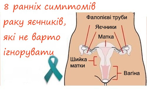 Симптоми раку яєчників, які не варто ігнорувати
