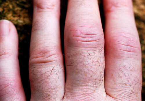 набряк суглобів пальців кисті при ревматоїдному артриті