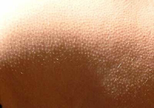 гусяча шкіра