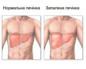 Запалення печінки. Причини та симптоми хвороби