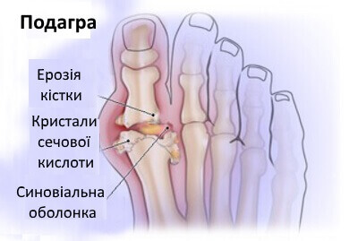 подагра