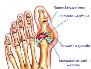 Як позбутися сечової кислоти в суглобах